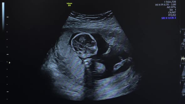 Ultrasound of Pregnant Woman alt