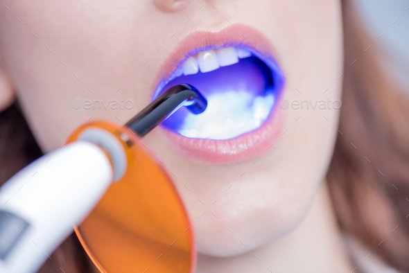 cropped shot of patient getting teeth cured with dental curing light