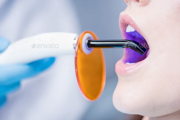 cropped shot of patient getting teeth cured with dental curing light