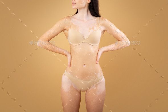 Proud Woman With Vitiligo Skin Disorder Standing In Underwear On Beige Background