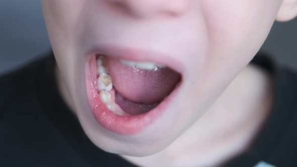 Baby Tooth in Mouth of a Tenyearold Boy He Sways It with His Finger Closeup