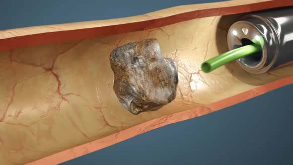 Kidney Stone Treatment. Lithotripsy. alt