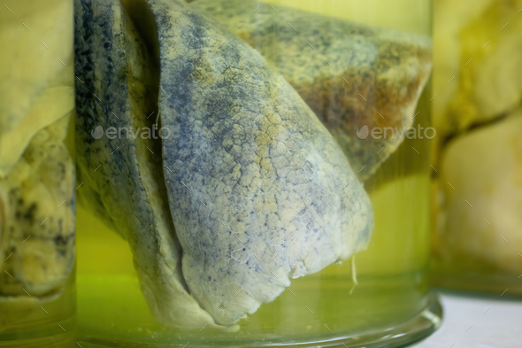 Lungs with cancerous changes floating inside jar with formaldehyde in morgue