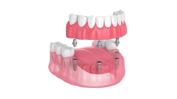 Partial denture bolted by implants isolated over white background