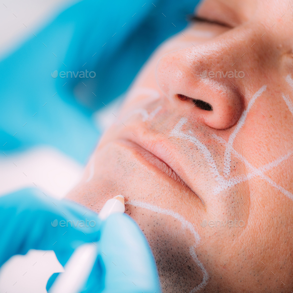Dermal Fillers for Men. Marking Man’s Face Before Dermal Filler Treatment
