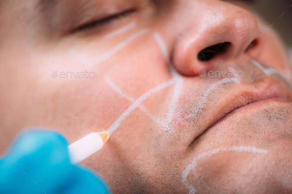 Dermal Fillers for Men. Facial Contouring Before Dermal Filler Treatment.