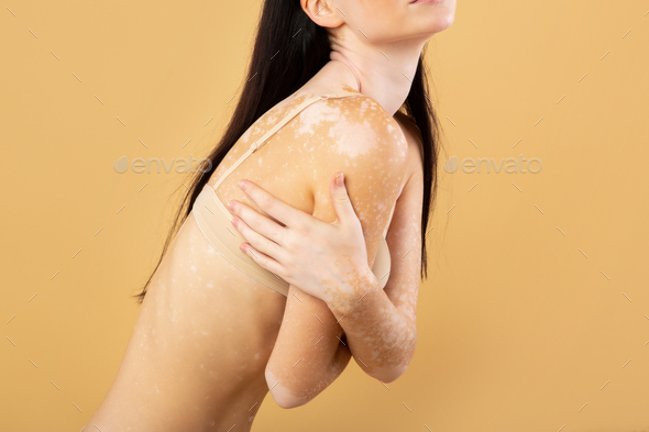 Skin Disorders. Cropped Shot Of Slim Female With Vitiligo Standing In Underwear