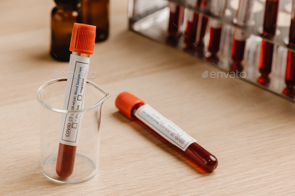 COVID-19 test and laboratory sample of blood testing for diagnosis new Corona virus infection