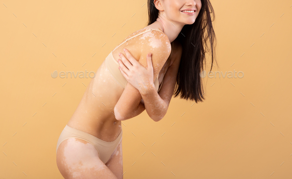 Cropped Shot Of Skinny Female With Vitiligo Skin Disorder Posing In Lingerie