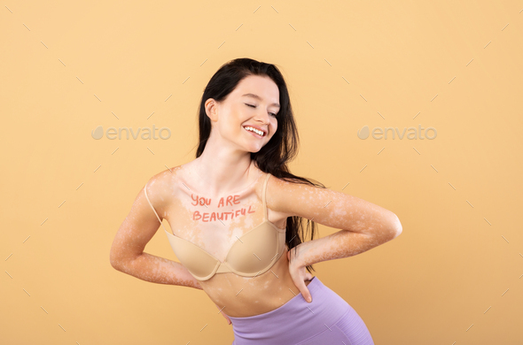 Enjoy Your Beauty. Portrait Of Happy Young Woman With Vitiligo Skin Disorder
