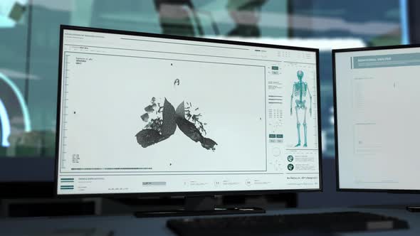 Diagnostic Scanner Analysing Patient With Lungs Infected By Covid Virus alt