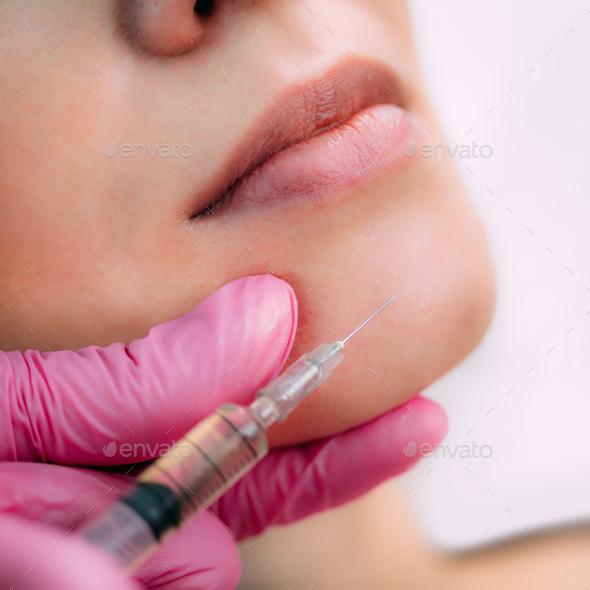 Dermal Filler Injection for Chin