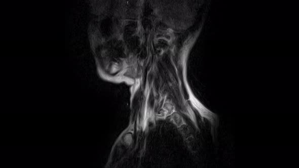 MRI of the Cervical Spine, Detection of Protrusions and Hernias alt