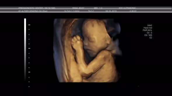 3D Ultrasonic Of A Baby
