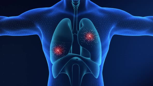 Lungs Cancer Visualization