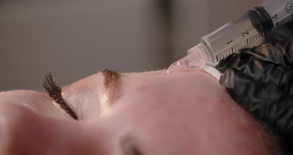 Cosmetologist Does Injections to the Woman's Face Botox and Hyaluronic Acid Rejuvenating Beauty