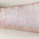 papules on inner side of forearm close up - PhotoDune Item for Sale