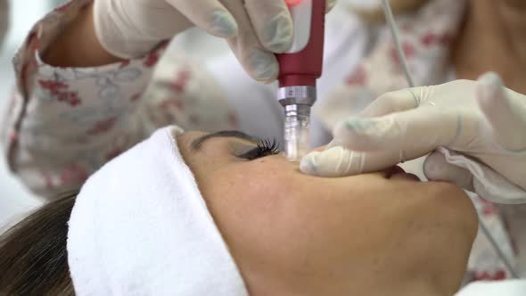 Dermapen Micro Needle Skin Therapy 4K alt