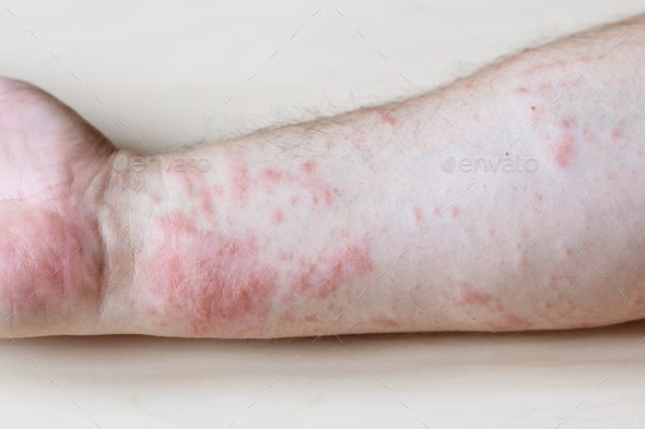 itchy rash on side of forearm close up