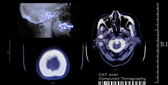 CAT Scan - CT Computed Brain Tomography On Monitor