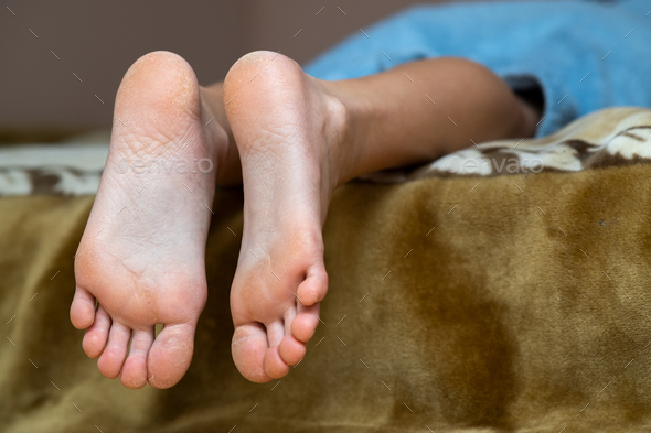 Closeup of woman feet sole with dry cracked skin. Foot and toes care concept