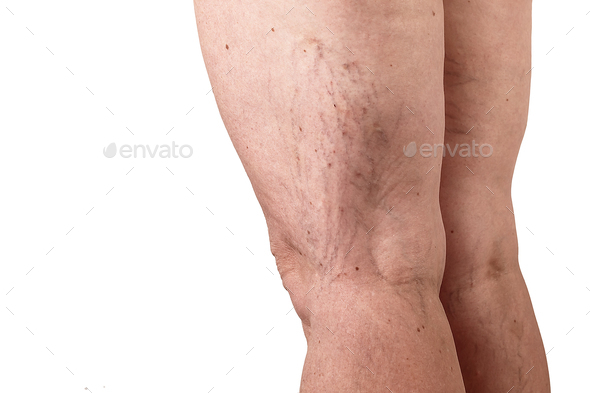 the disease varicose veins on a womans legs. white background - Stock Photo - Images