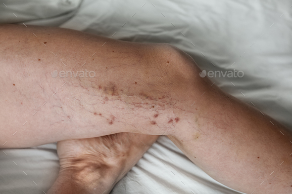 the disease varicose veins on a womans legs - Stock Photo - Images