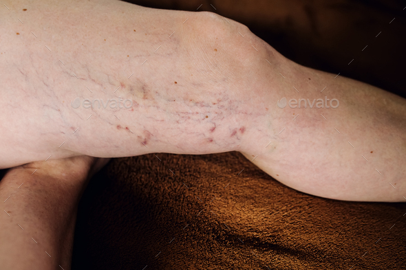 the disease varicose veins on a womans legs - Stock Photo - Images