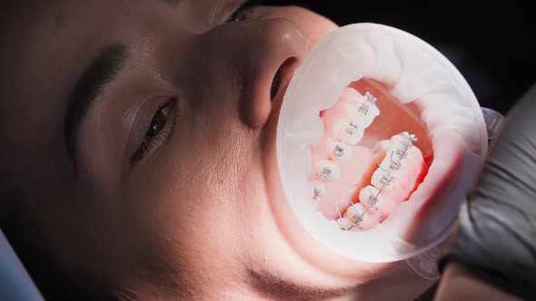Woman Dentist In a Medical Gloves Works with a Patient Girl in a Dental Office. Braces Installation alt