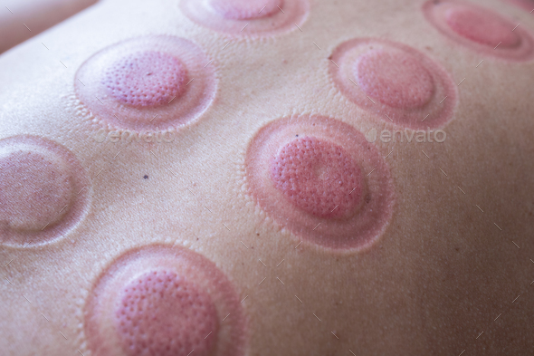 A man back with blood marks massaged after taking Chinese cupping therapy