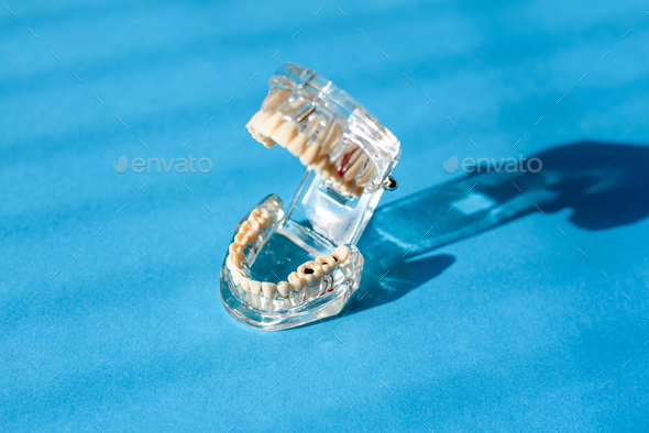 Artificial jaw model with denture, used by dentists, isolated on blue background.