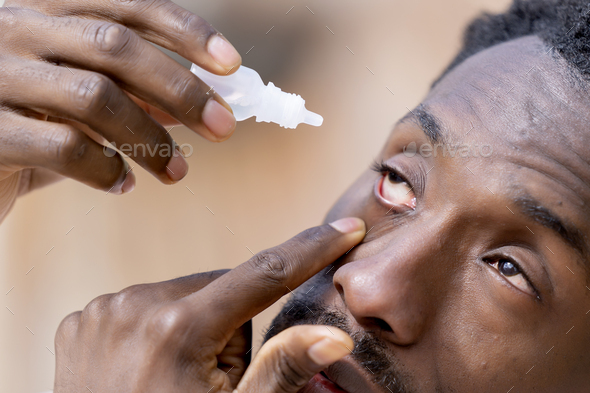 Close up of a black skinned man with dry eyes applying artificial tears in spring in a park