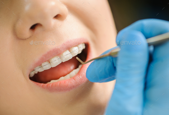 Woman with ceramic braces on teeth at the dental office