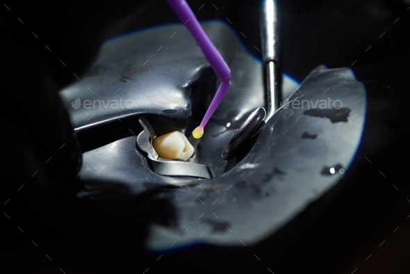 Closeup of fixing a tooth using a black rubber dam and dental instruments