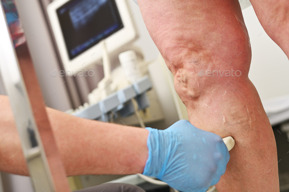 a phlebologist does an ultrasound of the veins of a patient with varicose veins.