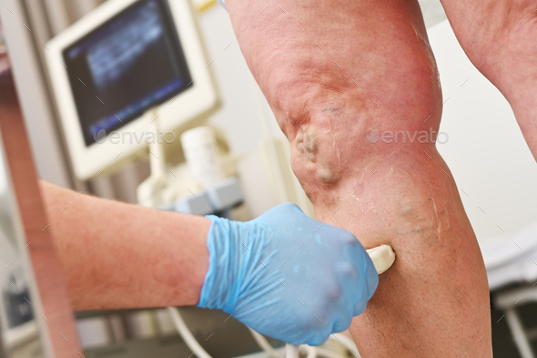 a phlebologist does an ultrasound of the veins of a patient with varicose veins.