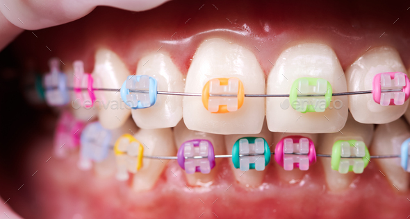 Macro snapshot of white teeth and ceramic braces with colorful rubber bands on them