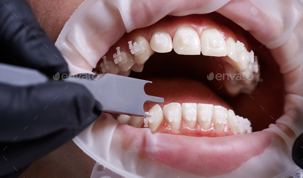 Dentist checking height of bracket placement with dental gauge.
