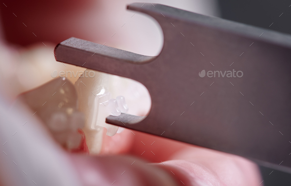 Dentist checking height of bracket placement with dental gauge.