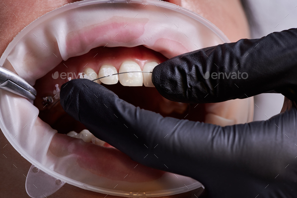 Dental procedure, process of attaching white ceramic braces and steel wire with a help of tongs