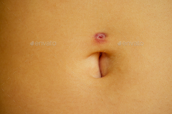 Belly piercing in the navel close up removal
