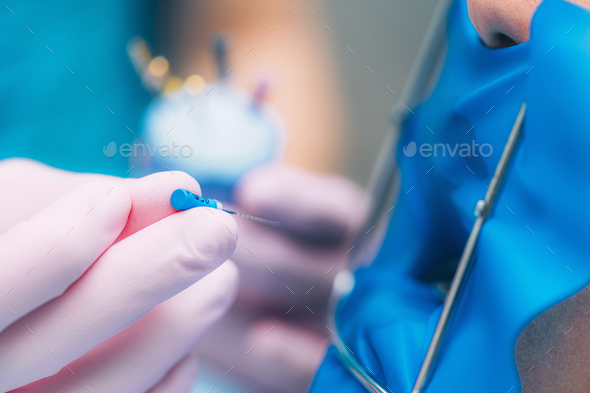 Endodontic Root Canal Treatment Process