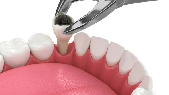 Tooth extraction and dental implant installation