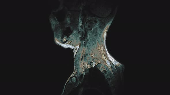 Bulk Multicolored MRI of the Cervical Spine, Detection of Protrusions and Hernias alt