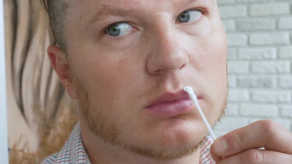A Young Man Rubs Ointment On A Wound On His Lip. Herpes On The Lip.