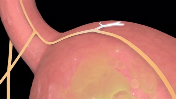 This video shows the gastroesophageal reflux alt