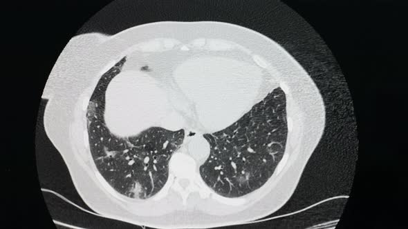 CT of Lungs with Confirmed Case of Coronavirus Covid19 Respiratory Disease alt