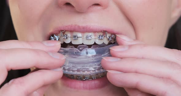 Woman Puts on Training Mouth Guard for Jaw Closeup alt