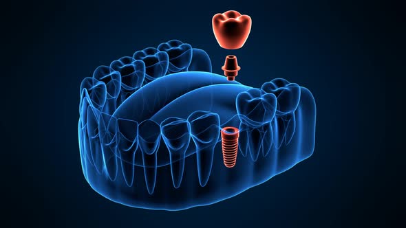 Dental implant placement on dark blue background