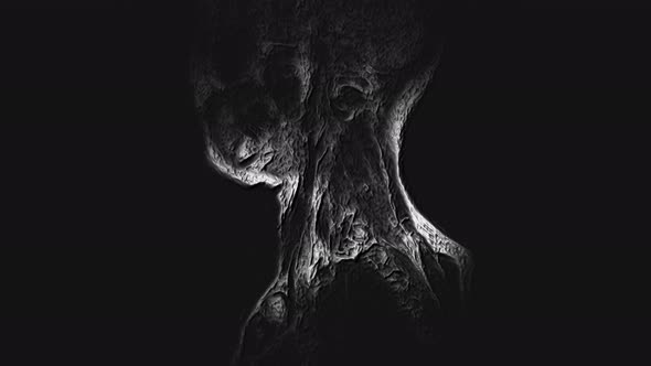 Voluminous MRI of the Cervical Spine, Detection of Protrusions and Hernias alt